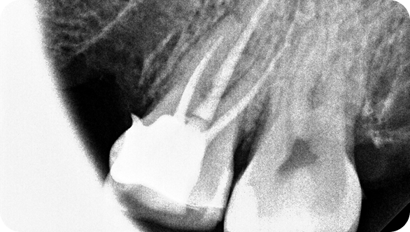 충치/신경치료 After