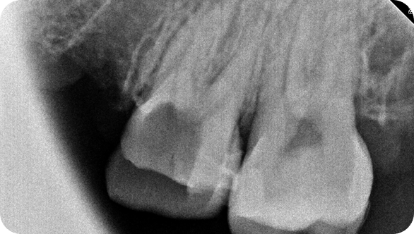 충치/신경치료 Before