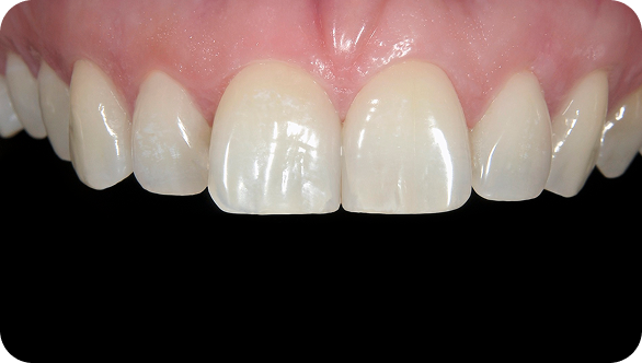 보철/심미치료 After