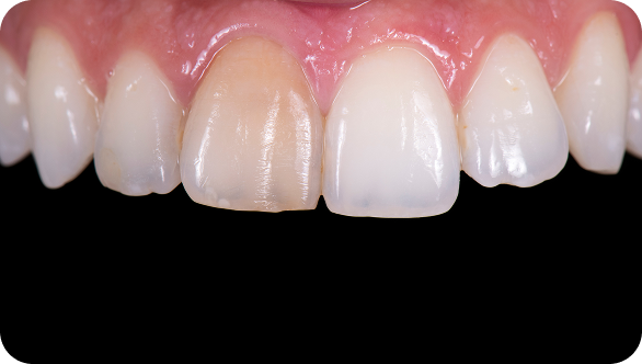 보철/심미치료 Before