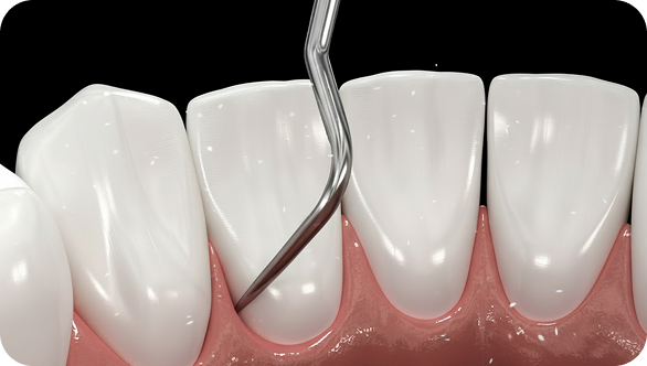 예방/치주치료 After