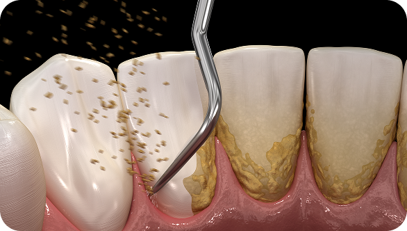 예방/치주치료 Before